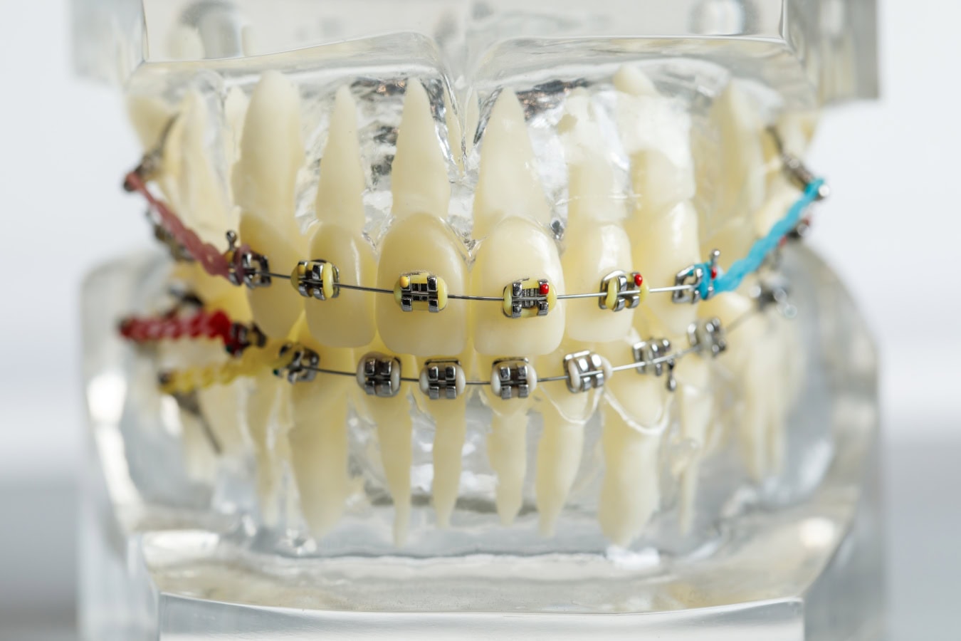Everything to Know About Braces